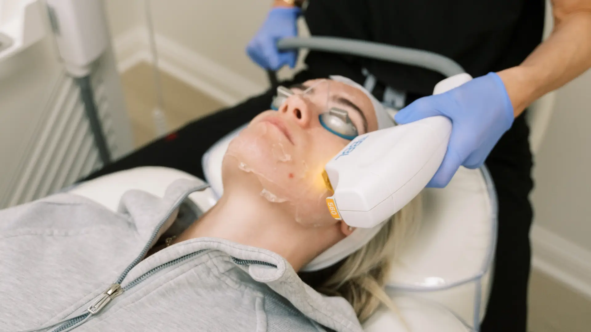 BBL laser treatment being performed for skin rejuvenation and pigmentation correction.