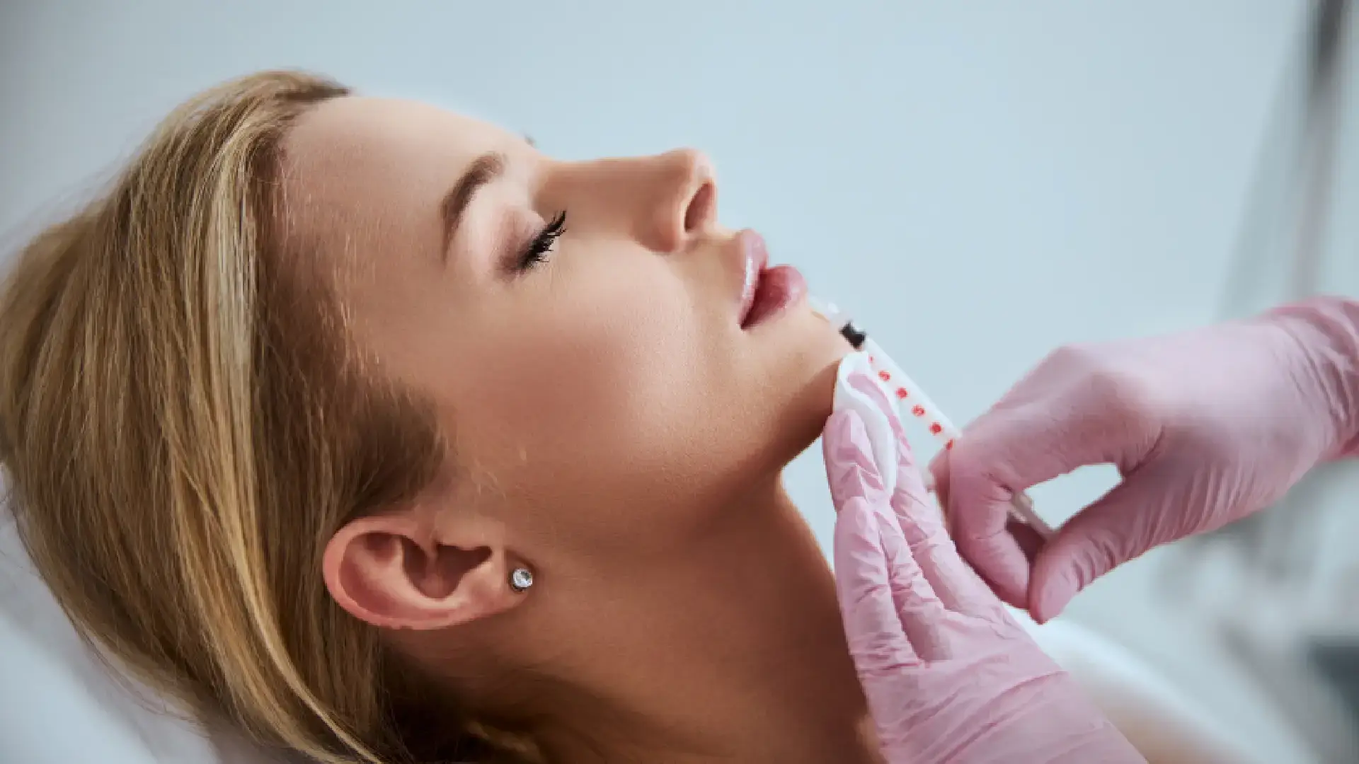 Radiesse dermal filler treatment for facial volume restoration and wrinkle reduction