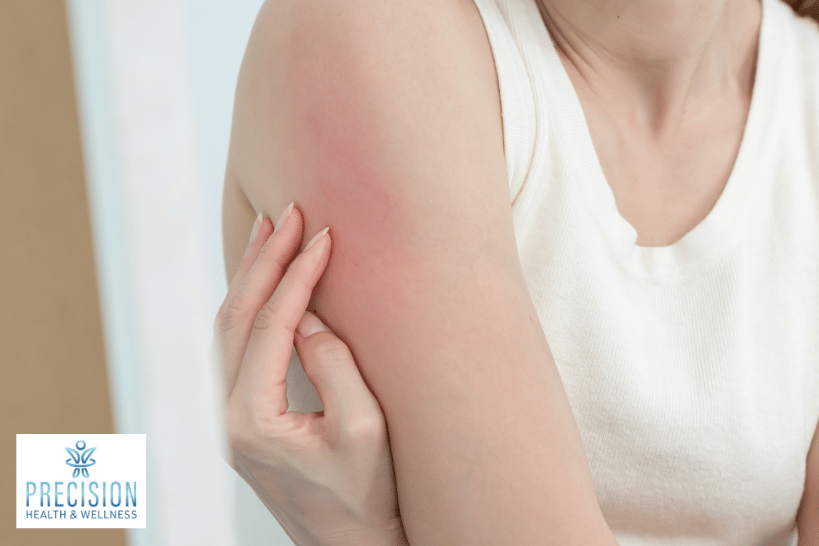 Close-up of irritated red skin on the arm showing possible side effects of hormone pellet insertion
